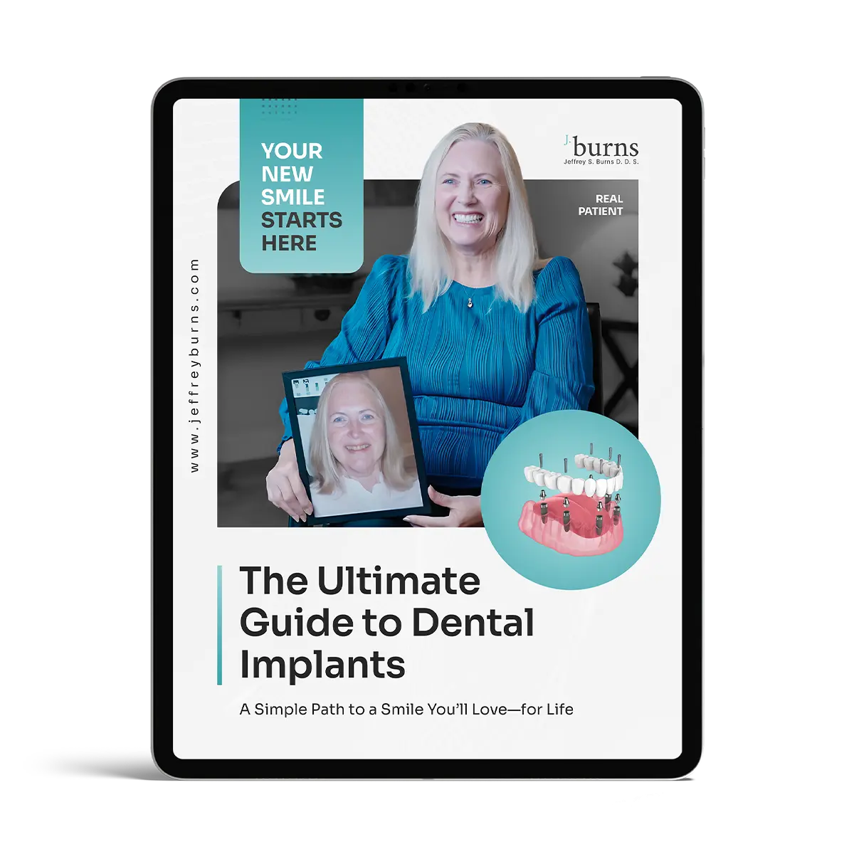Dental Implant Guide